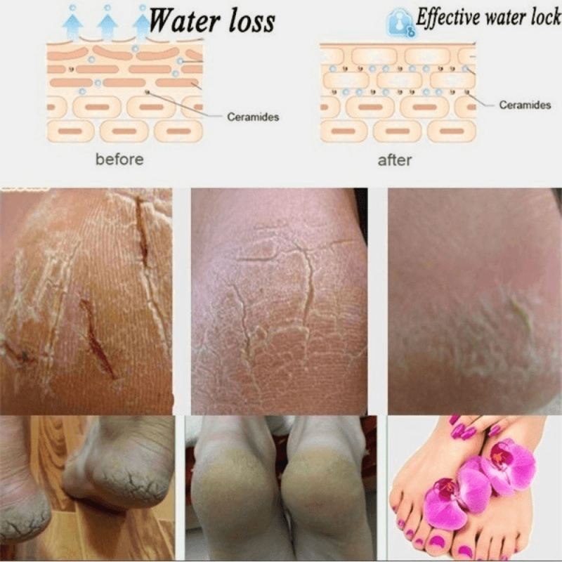 10 Par Silikone Anti-revne Sokker Fodpleje Revnet Fod Tør Hård Hud Beskytter Fugtgivende Spa Gel Sokker